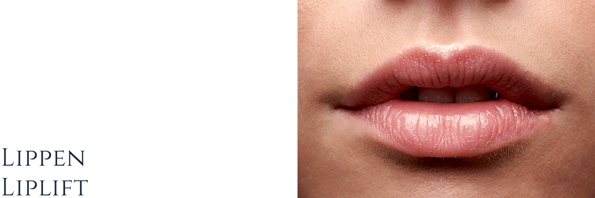Lippen / Liplift